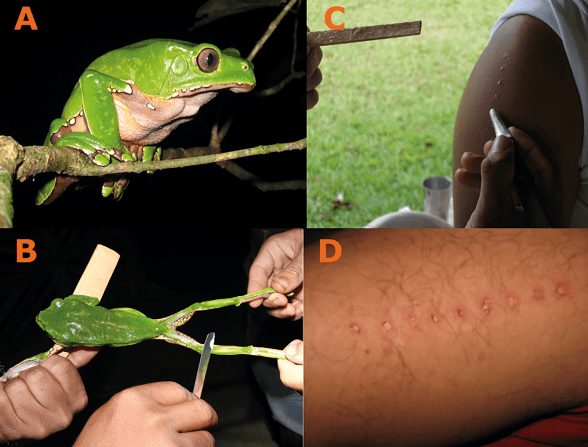Image split into 4 quadrants. Top left, marked A, is a Phyllomedusa bicolor, also known as Kambô or sapo. Bottom left, marked B, shows the frog tied off at each limb, while it's skin secretion is collected onto a stick. Top right, marked C, shows a human shoulder with small burn marks made in the skin to which the dried frog secretion is applied. Bottom right, marked D, is a close up of a human arm with burn marks from the Kambo ritual in a line pattern.